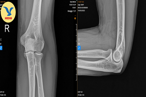 Chụp X quang khớp khuỷu gập và những điều cần biết